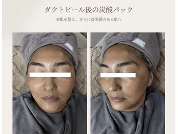 毛穴・肌質改善専門 private salon har’e【ハレ】　ピーリング/小顔の写真/【30代からの年齢肌に】蓄積したシミ・深層のシワへ働きかけハリと弾力溢れる素肌美人へ☆毛穴・肌荒れにも