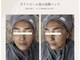 毛穴・肌質改善専門 private salon har’e【ハレ】　ピーリング/小顔の写真/【30代からの年齢肌に】蓄積したシミ・深層のシワへ働きかけハリと弾力溢れる素肌美人へ☆毛穴・肌荒れにも