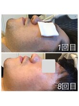 メンズ脱毛 ウィッシュ(Wish)/最新マシン☆ヒゲ脱毛の効果！