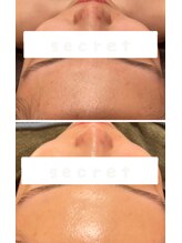 レイビス 仙台店(RAYVIS)/魔法のエステでの1回の効果！