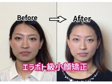 アコルデ 岡山問屋町(ACORDE)/小顔矯正ver.7