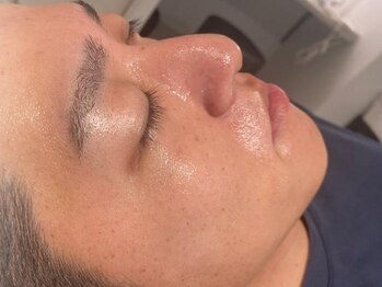 ベル(belle)の写真/【メンズ美肌☆碧ハーブピーリング￥8,800】キレイな肌の男がモテる時代！低刺激で憧れツル肌に☆