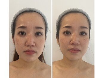 エムプリュ 心斎橋店(M.plus)/バスト施術一回！一度で小顔に！