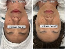 エミマス ボーテ(Emimas Beaute’)/６０代　幹細胞５回目