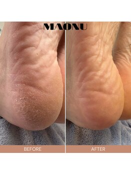 マオヌー(MAONU)/韓国式足裏角質ケア　症例写真