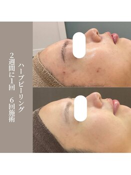 コンバートビューティーオタイ(ConBert Beauty otai)/ハーブピーリング