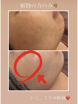 雅菜(miyabina)/シミ・くすみ軽減へ