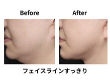 ティアレソワン(tiare soin)/フェイスラインすっきり