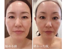 ムーン 高崎店(MOON)/オールハンドのたるみケア