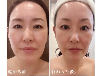 ムーン 高崎店(MOON)/オールハンドのたるみケア