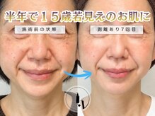 ココ 2号店(CoCo)/半年で15歳若みえのお肌に