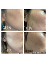 ポカポカ(pokapoka)/肌質改善TR &nbsp;しみ気になる方