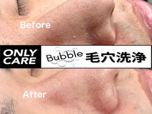 【Bubble毛穴洗浄！】専用の溶剤で皮脂を浮かして優しく吸引☆