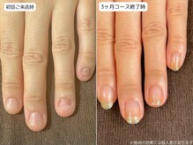 カピリナ(Ka Pilina)/自爪育成・深爪・川崎