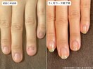 自爪育成・深爪・川崎