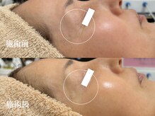 キーオブフェイス(Key of Face)/１度で違う！目尻のシワ劇薄っ！