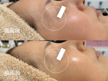 キーオブフェイス(Key of Face)/１度で違う！目尻のシワ劇薄っ！