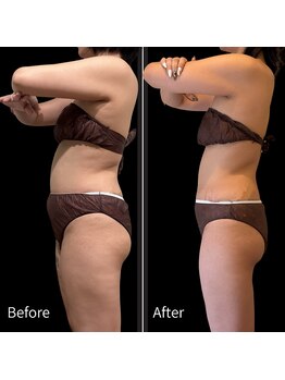 クールヴィラ(Cool Villa)/腹部太もも冷却4回+電磁パルス