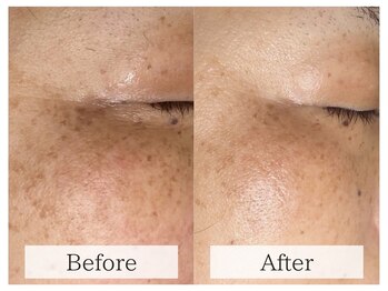 ルミラポー(Lumira Peau)/シミスポット+肌質改善