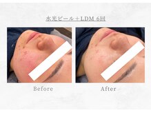 エヴァーグレース 三河安城店(EVER GRACE)/【肌管理】水光ピール＋LDM