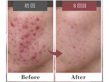 フルリール/【ニキビケアプロテクション】