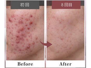 フルリール/【ニキビケアプロテクション】