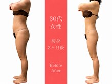 ムーン(MOON)/痩身全身before→after
