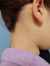 キアラ 麻布十番(Kiara)/うなじ脱毛　のアフター