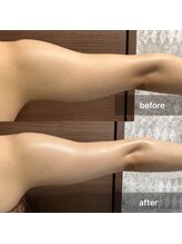 キノ(Kino)/二の腕脂肪冷却