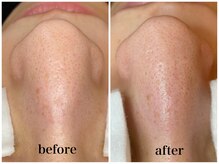 毛穴専科/ワックス脱毛メンズok/沖縄/那覇