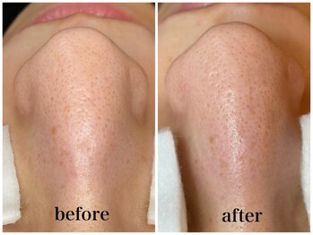 毛穴専科/ワックス脱毛メンズok/沖縄/那覇