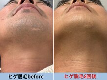 ミスターアンクール 鹿児島(Mr.uncoeur)/ヒゲ脱毛8回後