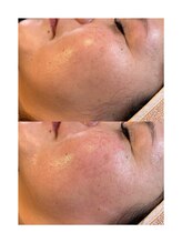 エーワキシング(A.Waxing)/