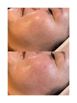 エーワキシング(A.Waxing)/