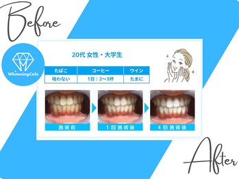 ホワイトニングカフェ 志木店/ホワイトニングbefore after3