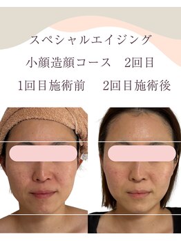 シンナリ(Shinnari)/before→after　2回目