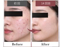 フルリール/【ニキビケアプロテクション】