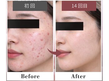 フルリール/【ニキビケアプロテクション】