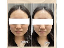 エンチャント(ENCHANT)/ウルトラお顔超音波リフト