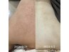 【背中肌荒れケア◎】ボディホワイトスノーピール¥9900→