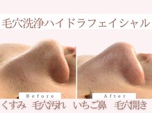 Cスキンケアクリニック 麻布店/ハイドラBeforeAfter