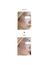 ビューティークリニックコダマ 国分店/【3ヶ月】A.H様 (20代) 肌荒れ