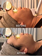 プライム(Prime)/顔脱毛でむくみが取れる！！