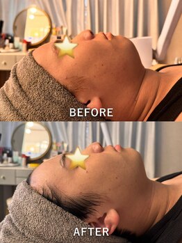 プライム(Prime)/顔脱毛でむくみが取れる！！