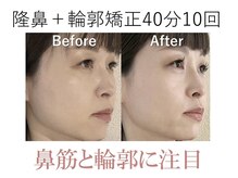 ラプリ 大阪心斎橋店(Raplit)/隆鼻＋輪郭矯正40分10回