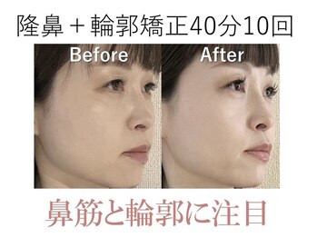 ラプリ 大阪心斎橋店(Raplit)/隆鼻＋輪郭矯正40分10回