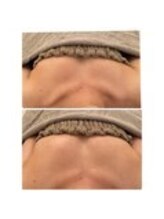 美人バスト 表参道店/バストアップ・左右差改善症例