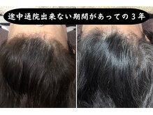 セントラル鍼灸院リラクシー(Re:laxy)/元々細かったが太くハリツヤに