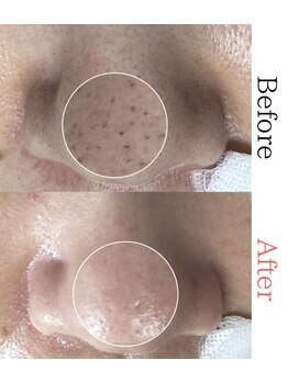 ボータン 恵(Beau Temps)/毛穴ケア/毛穴洗浄　【施術例】