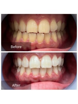 メンズ脱毛 リボーン(reborn)/ヘビースモーカーも大変身